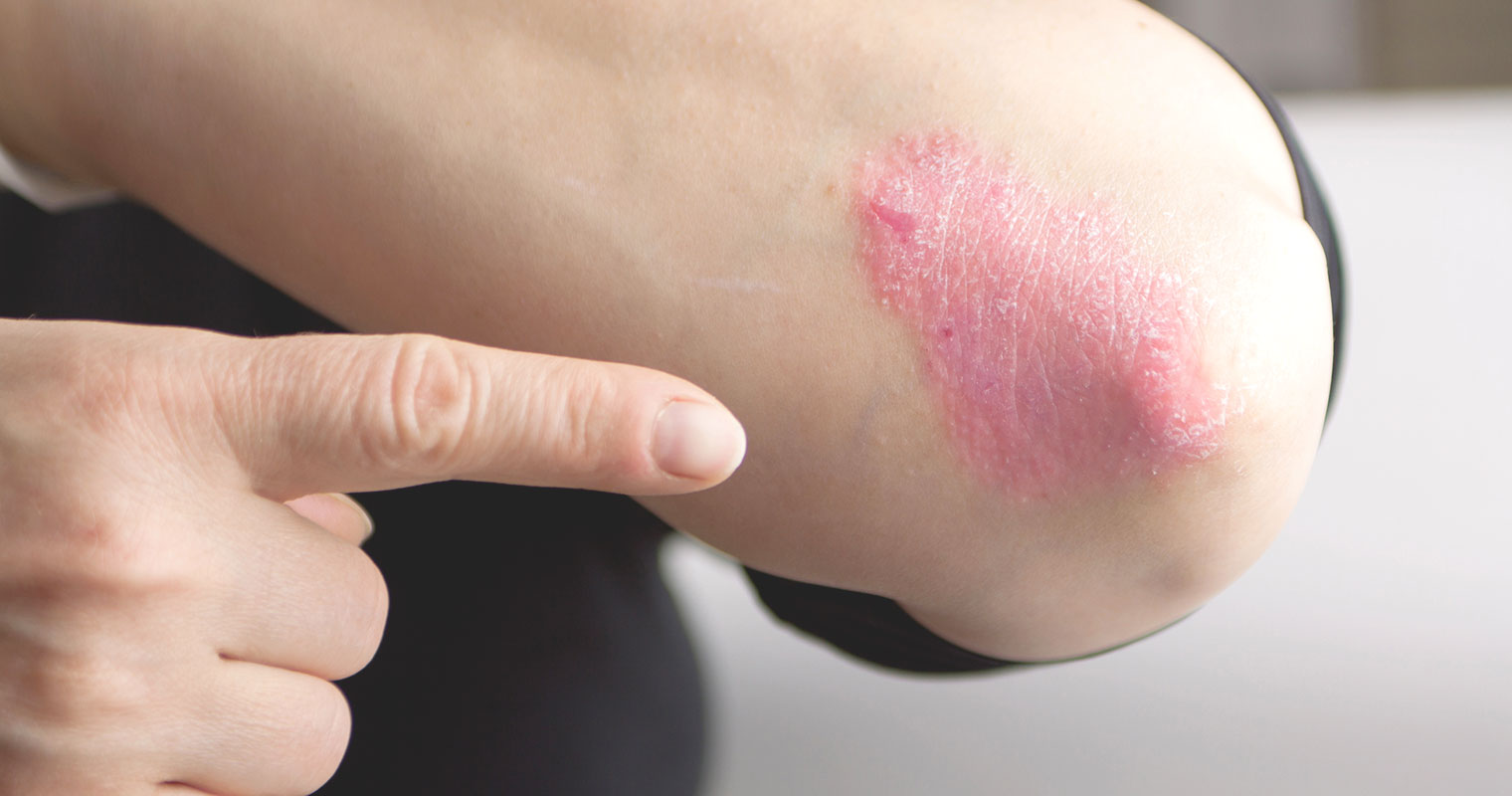 Eczema at the skin of elbow