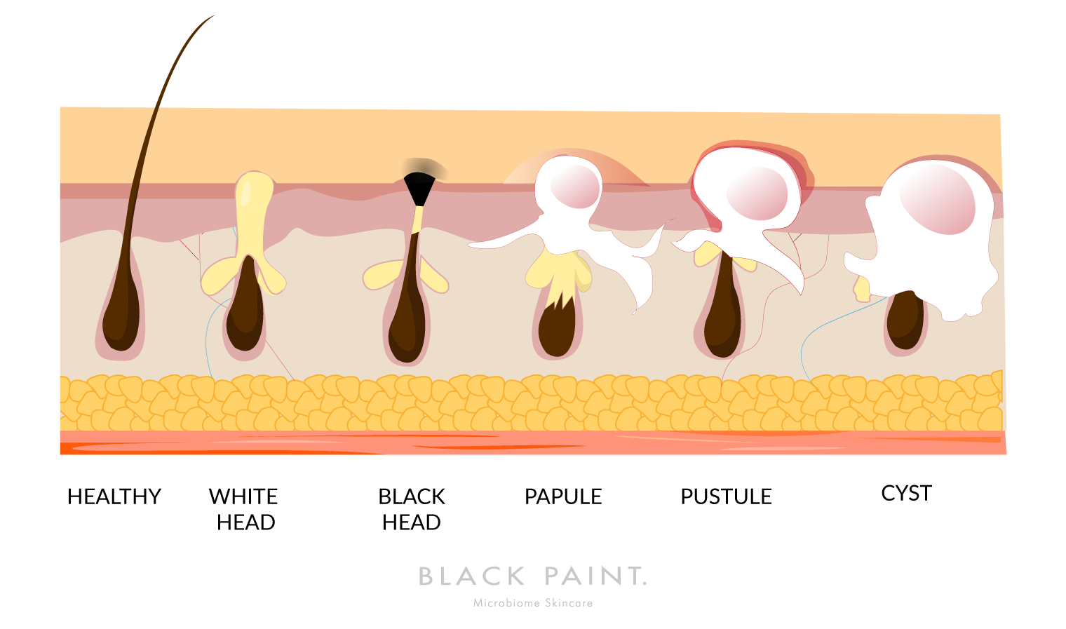 illustration of different types of skin pore problem