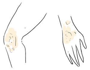 illustration of inflammation on the skin of hand and knee