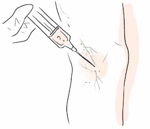 illustraion of sclerotherapy