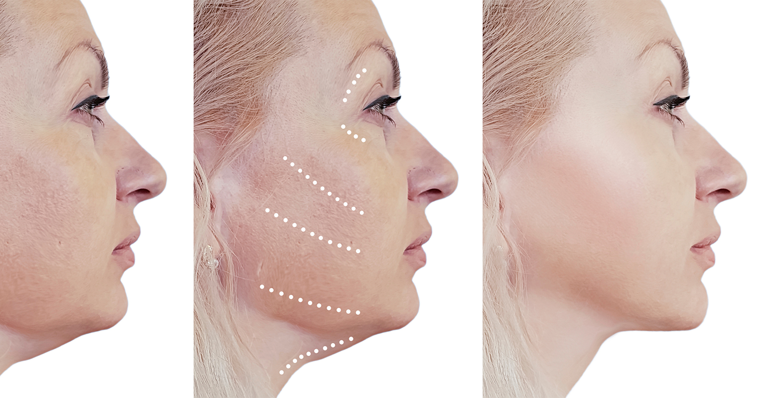 facelift before and after procedure