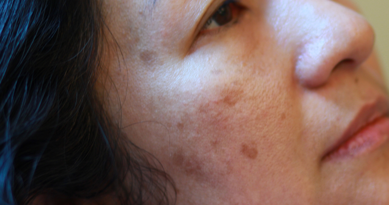 melasma on the right side of a woman's face