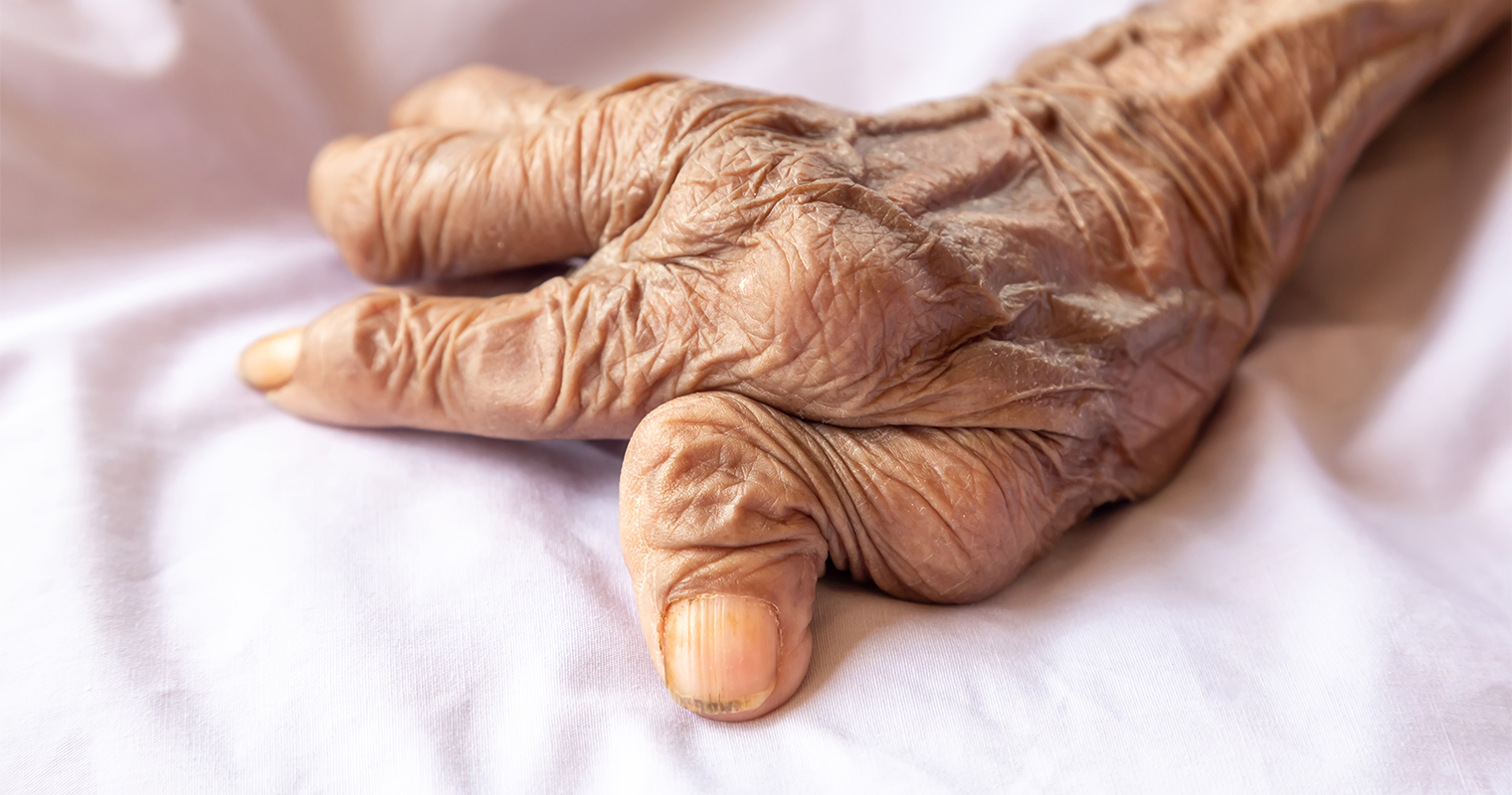 fingers of woman with rheumatoid arthritis